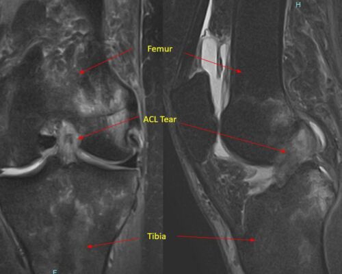 Pancio Orthopedics - 2420 Constitution Ave Olean NY 14760 - 716-373-5070 - Orthopedic Surgeon Sports Medicine and Joint Replacement Specialist - Knee Gallery 00001