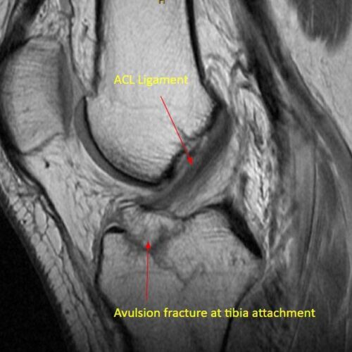 Pancio Orthopedics - 2420 Constitution Ave Olean NY 14760 - 716-373-5070 - Orthopedic Surgeon Sports Medicine and Joint Replacement Specialist - Knee Gallery 00002
