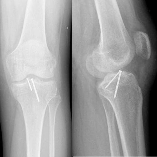 Pancio Orthopedics - 2420 Constitution Ave Olean NY 14760 - 716-373-5070 - Orthopedic Surgeon Sports Medicine and Joint Replacement Specialist - Knee Gallery 00003