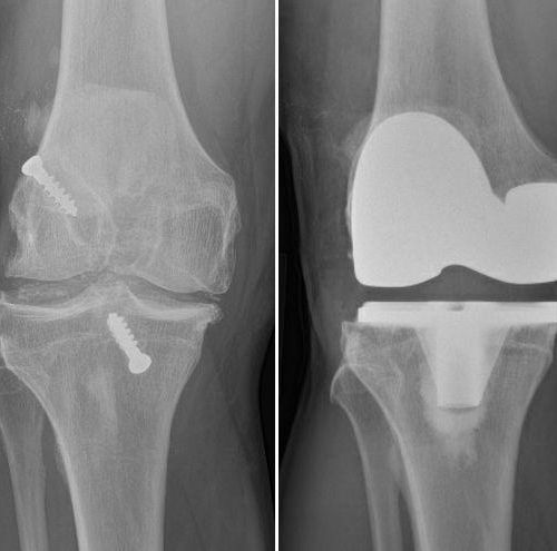 Pancio Orthopedics - 2420 Constitution Ave Olean NY 14760 - 716-373-5070 - Orthopedic Surgeon Sports Medicine and Joint Replacement Specialist - Knee Gallery 00004