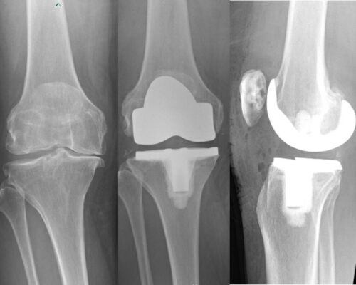 Pancio Orthopedics - 2420 Constitution Ave Olean NY 14760 - 716-373-5070 - Orthopedic Surgeon Sports Medicine and Joint Replacement Specialist - Knee Gallery 00005