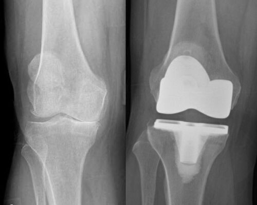 Pancio Orthopedics - 2420 Constitution Ave Olean NY 14760 - 716-373-5070 - Orthopedic Surgeon Sports Medicine and Joint Replacement Specialist - Knee Gallery 00006