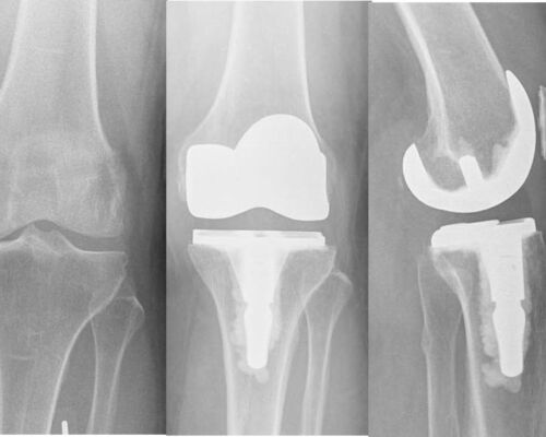 Pancio Orthopedics - 2420 Constitution Ave Olean NY 14760 - 716-373-5070 - Orthopedic Surgeon Sports Medicine and Joint Replacement Specialist - Knee Gallery 00007