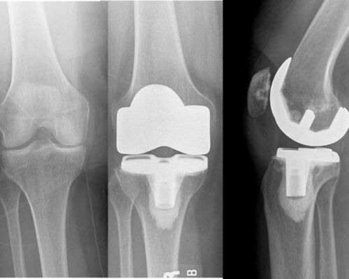 Pancio Orthopedics - 2420 Constitution Ave Olean NY 14760 - 716-373-5070 - Orthopedic Surgeon Sports Medicine and Joint Replacement Specialist - Knee Gallery 00008