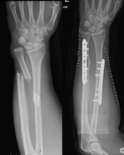 Pancio Orthopedics - 2420 Constitution Ave Olean NY 14760 - 716-373-5070 - Orthopedic Surgeon Sports Medicine and Joint Replacement Specialist - Trauma & Fracture Gallery 00001